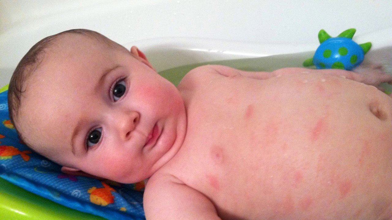 Các dấu hiệu bệnh ngoài da của trẻ sơ sinh bố mẹ cần biết